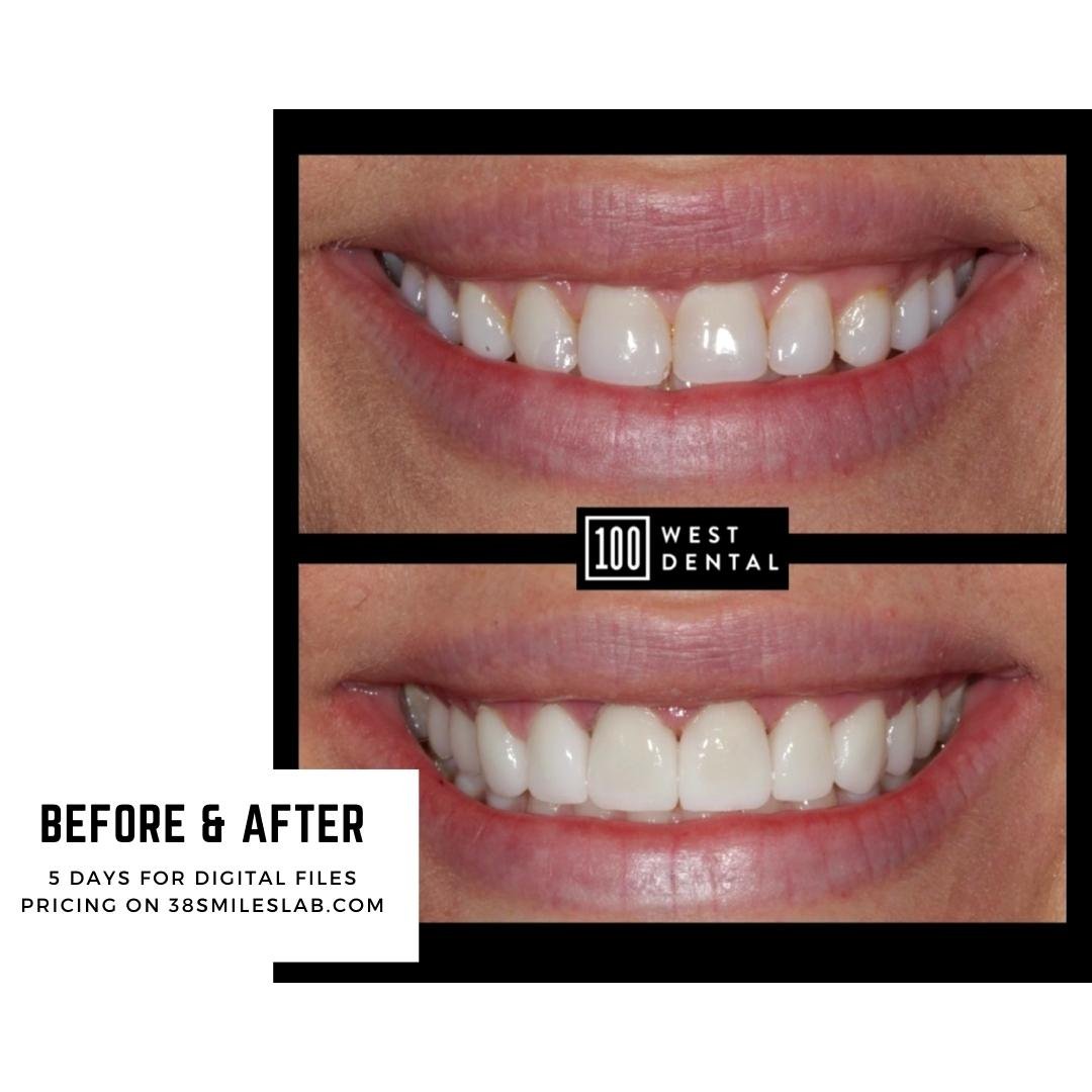 Veneers — 38 Smiles Dental Laboratory